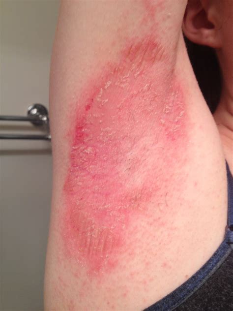 What Causes A Red Rash Under Your Armpits at Michael Marks blog