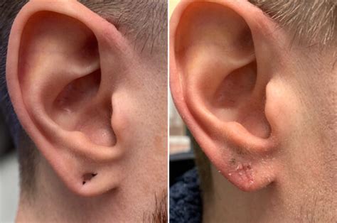 Ear Lobe Repair Before and After photo gallery