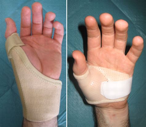 Basal Thumb Arthritis Treatment