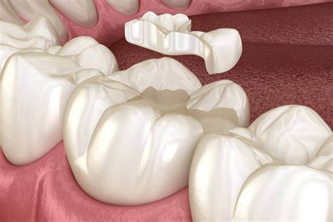 Inlays And Onlays • Ashland Family & Implant Dentistry