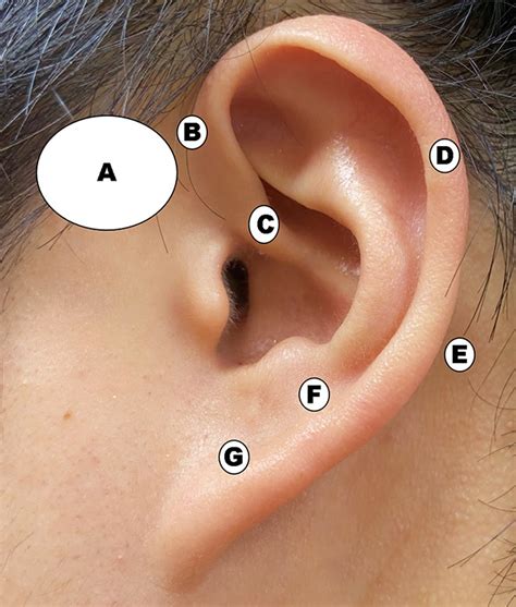 The Differences Between 2 Cases of Preauricular Fistula - Ye Jin Cho, Hyun Jin Min, Kyung Soo ...