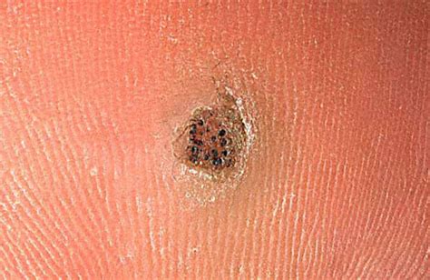 Plantar mosaic warts = الثأليل الاخمصية الفسيفسائية