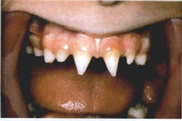 porphyria teeth - TheTwinDoctors.com