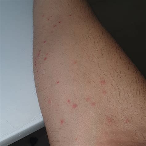 Little Red Dots On Skin Bug Bites