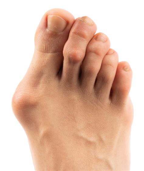 Bunions – Golden Triangle Foot & Ankle Specialists