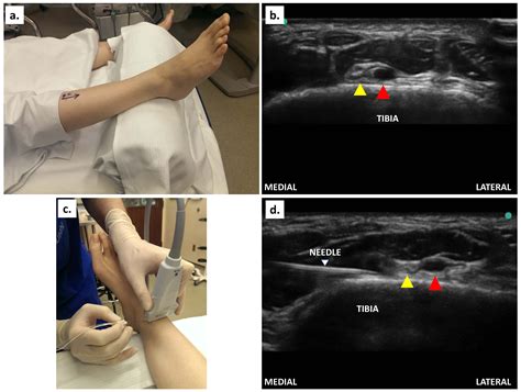 How I Do It: Ultrasound-Guided Ankle Block