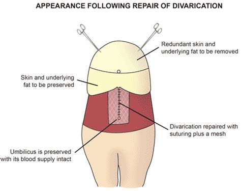 Divarication - Melbourne Hernia Clinic