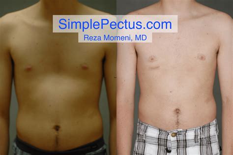 SIMPLE Pectus Repair Before & After Photo Gallery — Simple Pectus Excavatum Repair