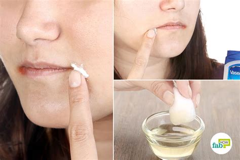 How to Get Rid of Angular Cheilitis | Fab How