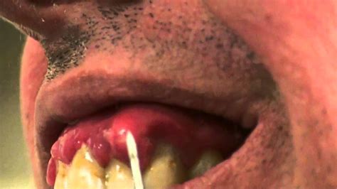 Lancing an Abscess Are Home Treatments Good or Bad for Dental Abscess - YouTube