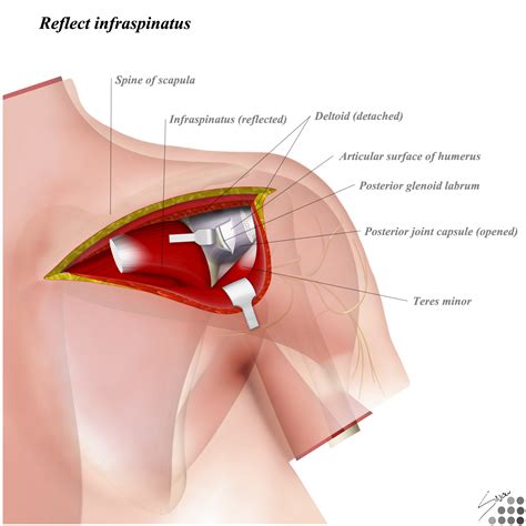 Posterior to Shoulder - Approaches - Orthobullets