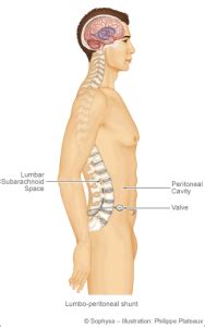 Lumboperitoneal Shunt | Pacific Adult Hydrocephalus Center