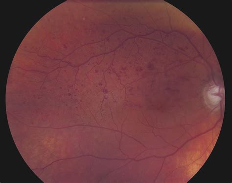 Cystoid Macular Edema | Ento Key