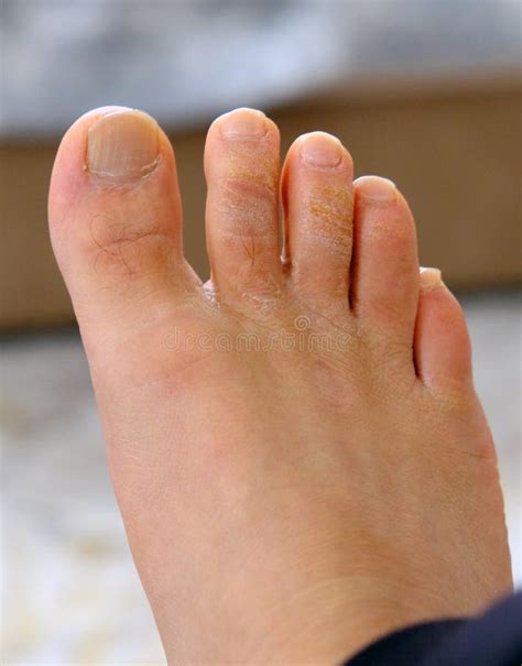 Fungal Disease on the Toes, Fungus Formation on the Toes, Human Foot and Fungus Stock Photo ...