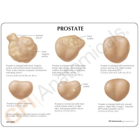 Prostate Conditions Model 3000 | Prostate Anatomy | GPI Anatomicals