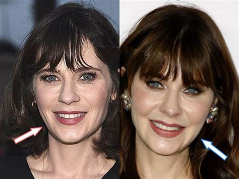 Zooey Deschanel Botox And Plastic Surgery - Before And After