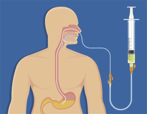 Information on Gastric Feeding Tube and Nasogastric Feeding Tube