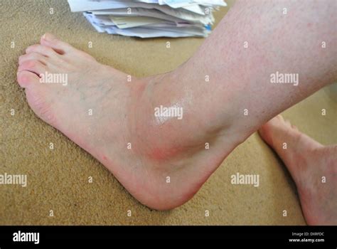 Gout ankle swelling Stock Photo - Alamy