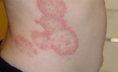 6 Painful Fungal Infections: Causes, Symptoms, and Treatments