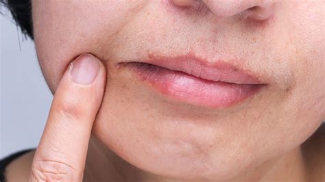 Apa itu Angular Cheilitis? - Unair News