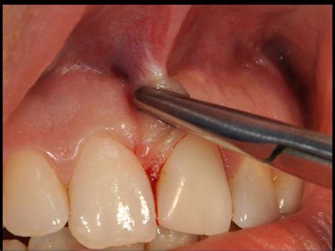 Labial frenectomy with Nd:YAG laser and conventional surgery