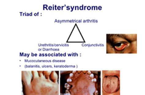 Reiter Disease