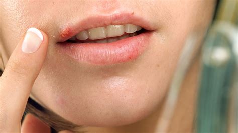Weird Rash Around My Lipstick | Lipstutorial.org