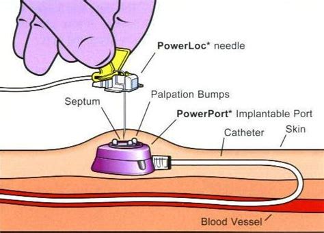 jm's Adventure with Multiple Myeloma: Intravenous Access Port - Bard Power Port June 13 2011