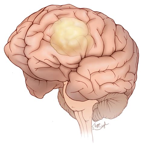 Brain Tumor | Expert Surgeon | Aaron Cohen-Gadol, MD