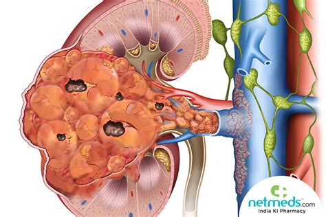 Sindroma Nefritik Patofisiologi, Diagnosis, Penatalaksanaan, 41% OFF