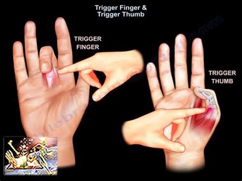 Trigger Finger