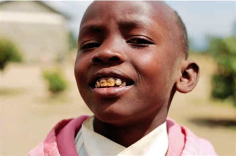 Dental Fluorosis in Kenya - causes and treatment - House of Dentistry