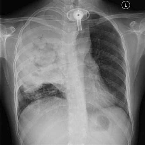 Axial CT image showing poststenotic atelectasis in the right upper lobe... | Download Scientific ...