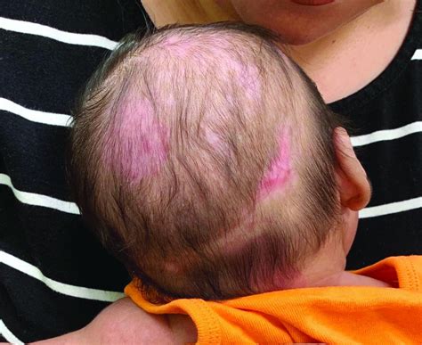 Seborrheic Dermatitis Scalp Infant