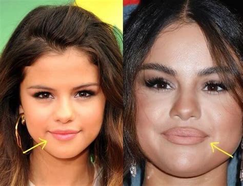 Selena Gomez Plastic Surgery: Rumors, Before & After Photos ...