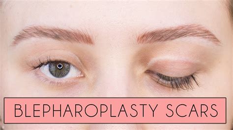 Eyelid Surgery Recovery Photos Eyelid Surgery Cost