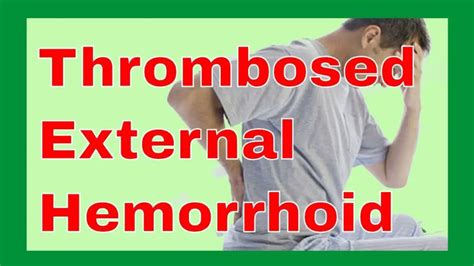 Thrombosed External Hemorrhoids - The Natural Cure