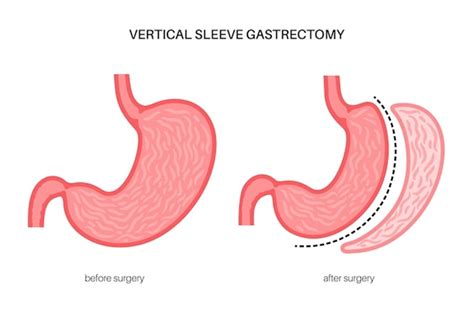 Gastric Sleeve Revision: What You Need to Know - Living With Healthy Hunger