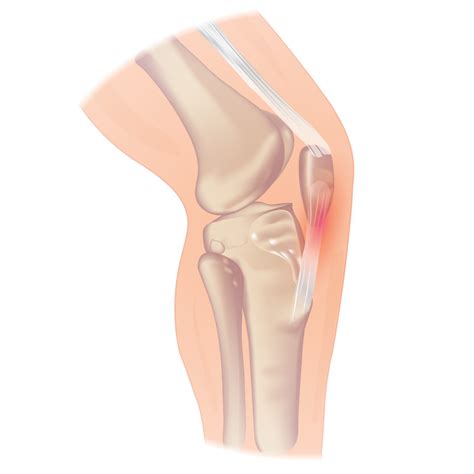 Patellar Tendinitis: The Kryptonite of Jumping Athletes | Biomechanics in the Wild