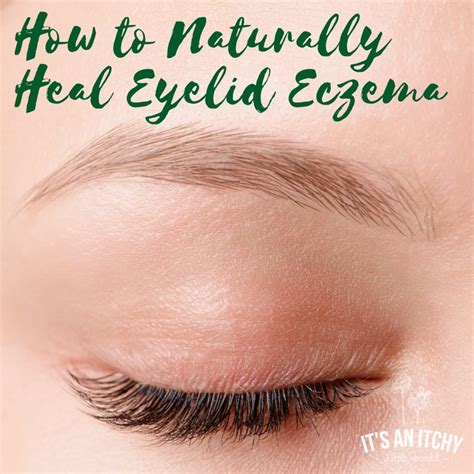 How to Naturally Heal Eyelid Eczema | It's an Itchy Little World