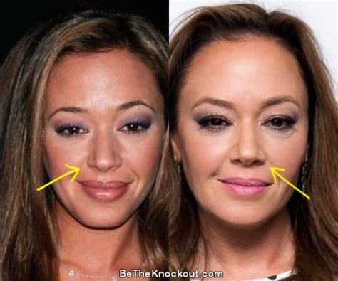 Leah Remini Plastic Surgery Comparison Photos