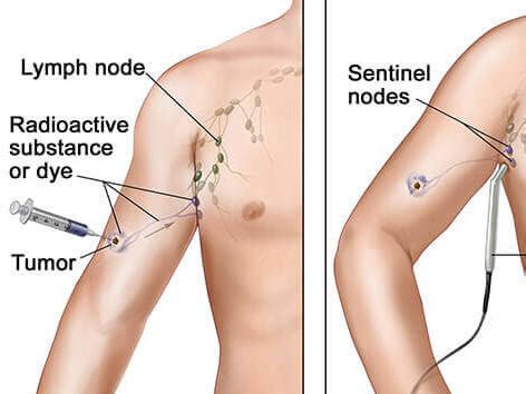 Sentinel Lymph Node Biopsy - NCI