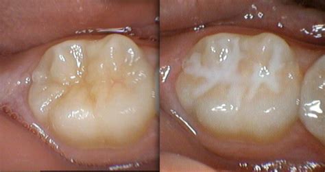 What are Fissure Sealants? - Crestmead Dental