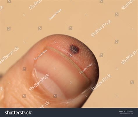 Blood Blister On Finger Injuried Accidental Stock Photo 757365502 ...