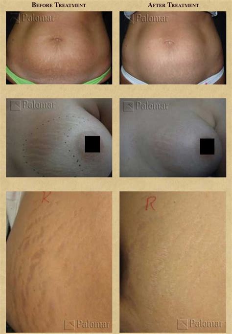 Laser Stretch Mark Removal Before And After Photos