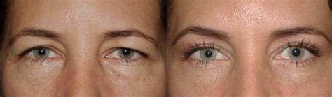 Brow lift with upper and lower blepharoplasty - Dr. Guy Massry