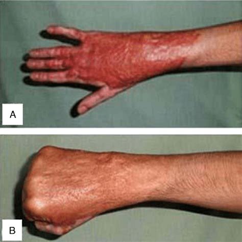 A, A 17-year-old male with hypertrophic scar in the dorsum of right ...