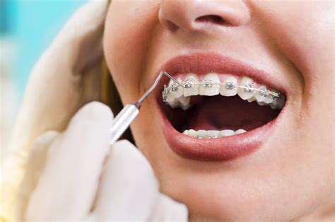 7 Types Of Orthodontics - Santa Cruz Smiles