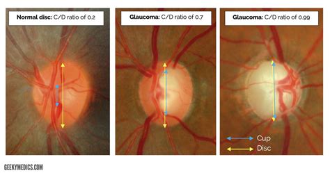 Acute Angle Closure Glaucoma Fundoscopy