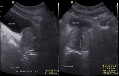 Transabdominal ultrasound of the prostate showing measurement of the... | Download Scientific ...